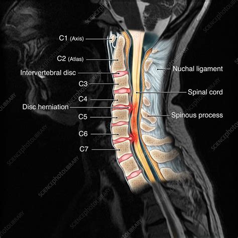 Cervical Spine Injury Mri Illustration Stock Image C0277459