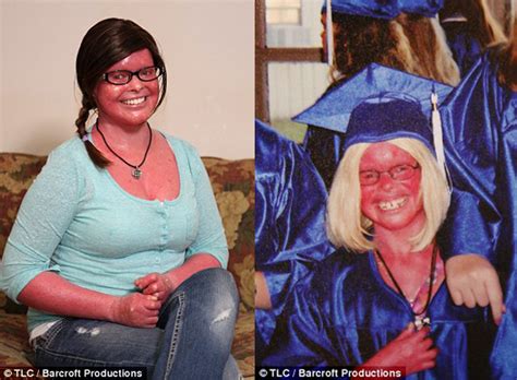 Ichthyosis vulgaris is a skin condition where the skin's surface becomes dry, thick, and scaly. Woman With Bright Red Skin Gets Pregnant And Decides To ...