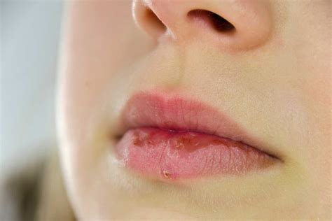 Bumps On Lips Small Little White Or Red Causes And Treatment American Celiac