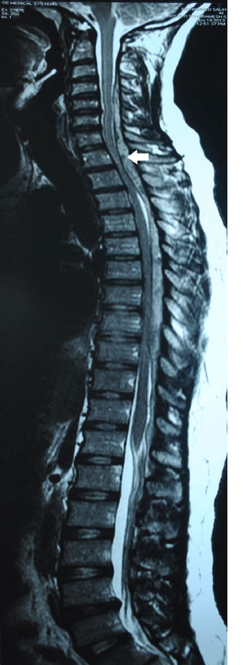 T2 Weighted Sagittal Mri Showing Extradural Lesion Extending From C3 To