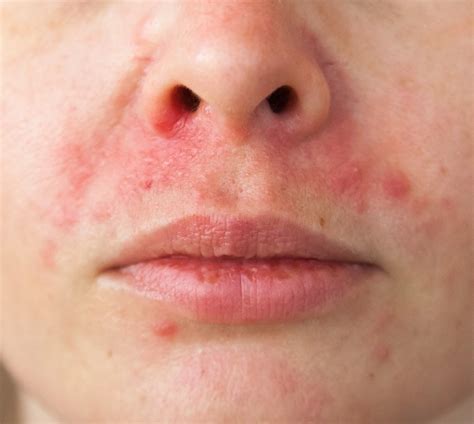 Perioral Dermatitis What Is It And How Can Your Skin Care Help To Cu
