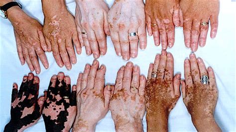 Vitiligo O Que é Causas Sintomas E Tratamentos Dicas De Saúde