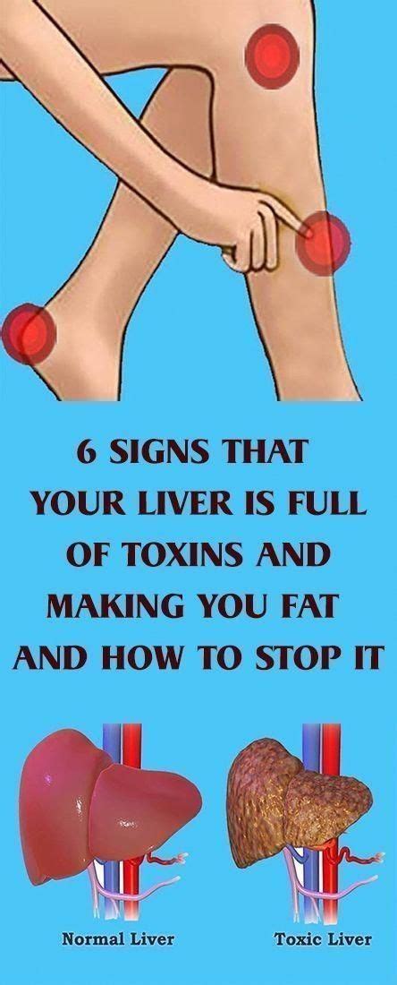 6 Signs That Your Liver Is Full Of Toxins In 2020 Liver Detox Liver Problems Fatty Liver Disease