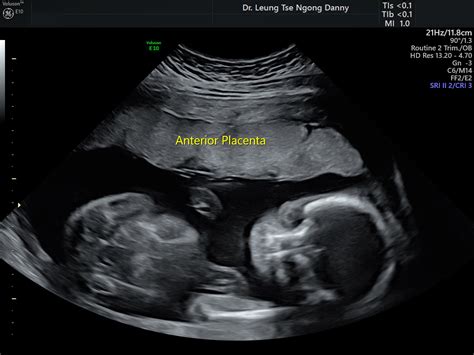 Routine Fetal Morphology Scan Hkog Info