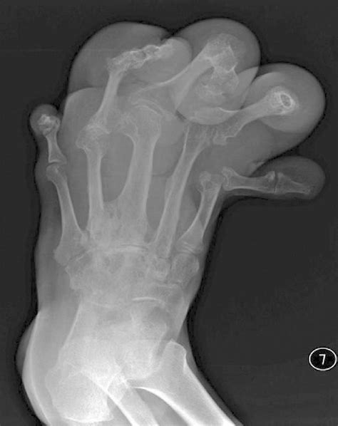 Plain Radiograph Shows Soft Tissue Swelling Involving Second Third