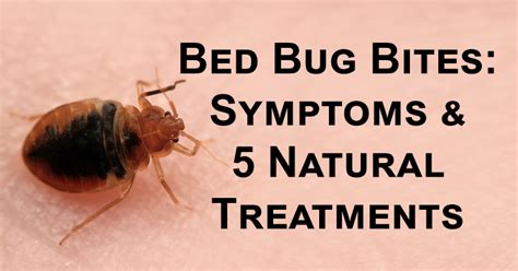 Bed Bug Bites Treatment