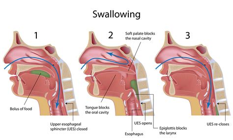 Can Speech Therapy For Parkinsons Disease Improve Swallowing Put