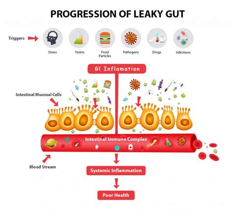 Can Leaky Gut Syndrome Cause Autoimmune Problems Integrative Medicine