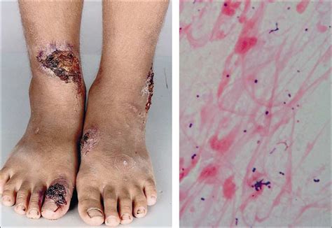 Skin Ulcers In A Returned Traveller The Lancet