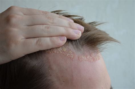Scaly Scalp You May Have Seborrheic Dermatitis The Pretty Pimple