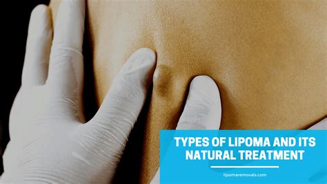 Types Of Lipoma And Its Natural Treatment Lipoma