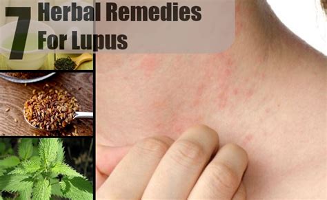 7 Amazing Herbal Remedies For Lupus How To Treat Lupus