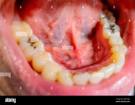 The Sublingual Gland Stone Disease In Mouth Stock Photo Alamy
