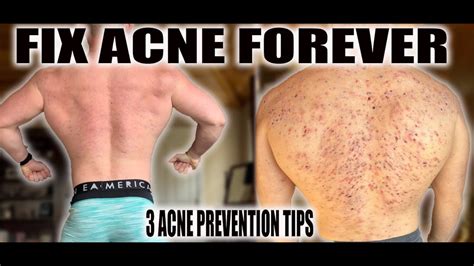 Extreme Steroid Acne 3 Tips For Perfect Skin Youtube