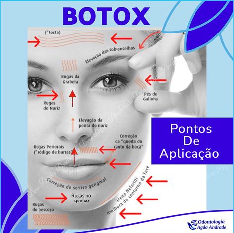 Botox S Na Testa Resolve