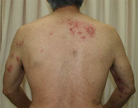 Disseminated Herpes Zoster Causes Symptoms Diagnosis And Treatment