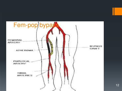 Femoral Popliteal Bypass Anatomy