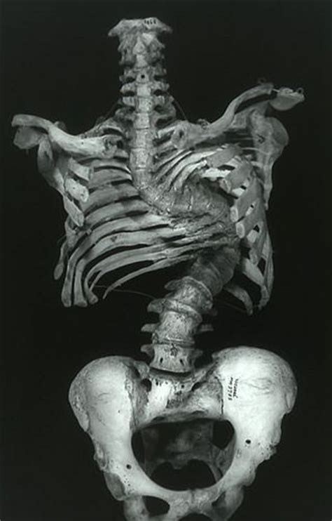 30 Best Images About Medical Oddities Mutations Etc On Pinterest
