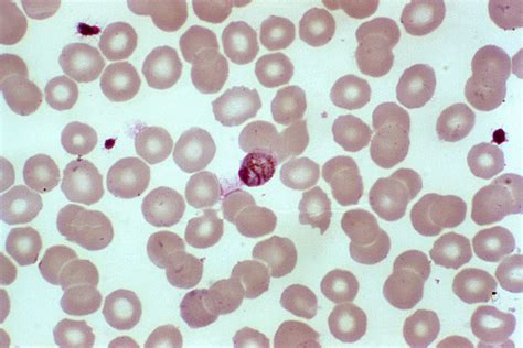 Free Picture Photomicrograph Shows Mature Plasmodium Malariae