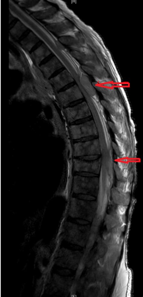 Cureus A Rare Case Of Acute Cord Compression From Spinal Myeloid