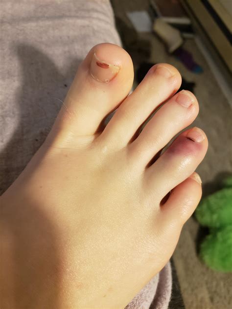 I Stubbed My Toe Yesterday And Now It Hurts A Bit When I Walk And When