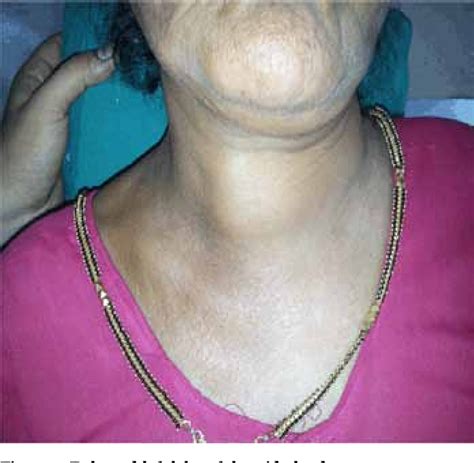 Figure 1 From Uncommon Metastasis To Thyroid Gland Presenting As A