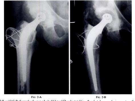 Figure 2 From The Outcome Of Charnley Total Hip Arthroplasty With