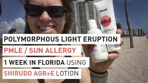 Polymorphous Light Eruption Pmle Sun Allergy 1 Week Florida