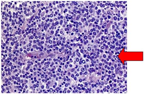 Diffuse Large B Cell Non Hodgkins Lymphoma In A 65 Year Old Woman