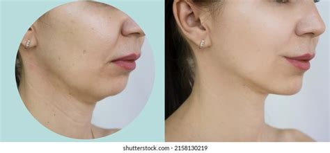 Woman Double Chin Before After Treatment Stock Photo 1846427785