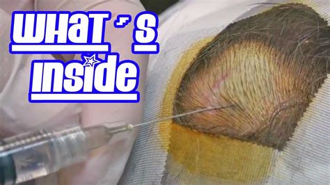 Whats Inside This Pilar Cyst Pimples Cysts And Dilated Pores Youtube