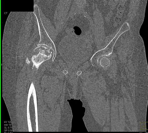 Avascular Necrosis Avn With Subchondral Collapse Right Femoral Head