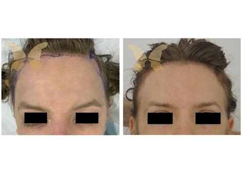Hairline Lowering Sydney The Plastic Surgery Clinic