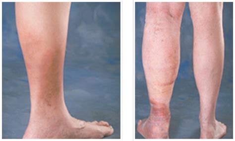Ankle Discoloration Can Signal Serious Vein Problems