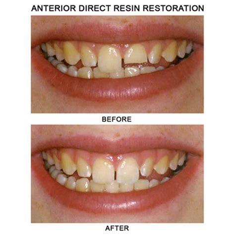 Before And After Precision Dental Nyc
