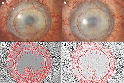 Bevacizumab Avastin Eye Drops Inhibit Corneal Neovascularization