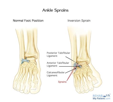 Inversion Sprain Of The Ankle Rehab My Patient