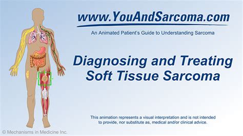 Diagnosing And Treating Soft Tissue Sarcoma
