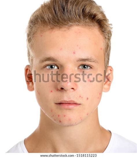 Teenage Boy Acne Problem On White Stock Photo 1518115223 Shutterstock