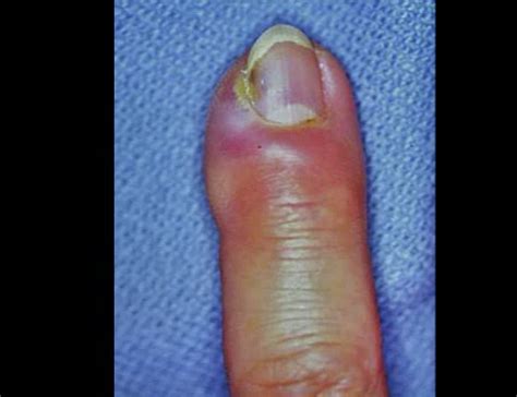 Acute Paronychia The Dark Side Of Nail Biting — Brown Emergency Medicine