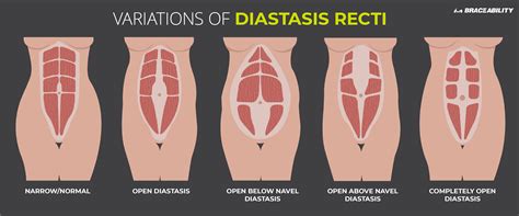 I did speak to my doctor about my diastasis recti and she was able to refer me to visit a physical therapist, another option for treatment of diastasis recti. A Complete Guide to Diastasis Recti: Truths on Abdominal ...