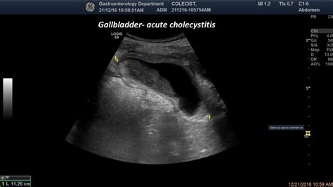 Acute Cholecystitis As Related To Abdominal Pain Pictures