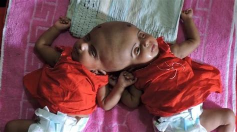 How Do Conjoined Twins Have Sex Or Be In Sexually Active Relationships And Still Maintain Their