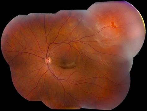 Svetlana pilyugina, a retina specialist at assil eye institute of los angeles, discusses retinal tears: Retinal Detachment with Horseshoe Tear - Retina Image Bank