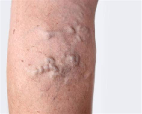 What Are The Long Term Side Effects Of Vein Ablation Vein Center In