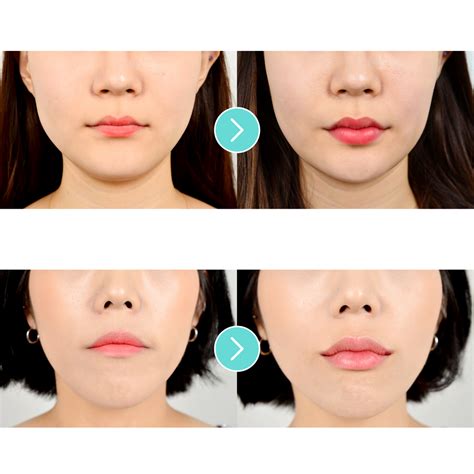 Lip And Lip Corner Lifting Fillers The Best Of Beauty In Seoul Korea By Eunogo Eunogo
