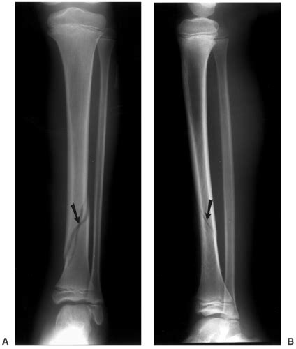 Fractured Fibula X Ray