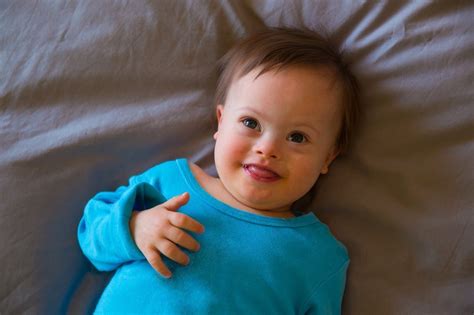 What Causes Down Syndrome Down Syndrome Causes Symptoms And