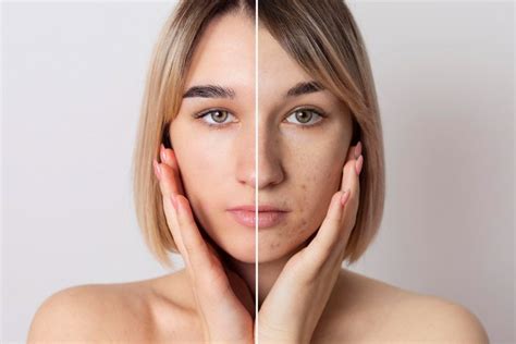 How To Get Rid Of Skin Discoloration With Skin Resurfacing Treatments