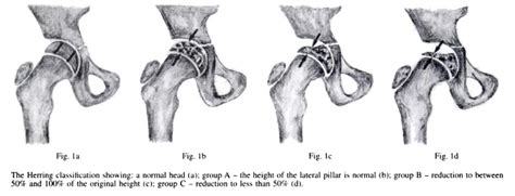 Legg Calve Perthes Disease Pediatrics Orthobullets